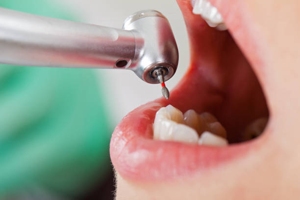 Best Emergency Wisdom Tooth Extraction in Prairie View, TX